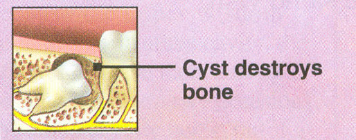 cyst on wisdom tooth